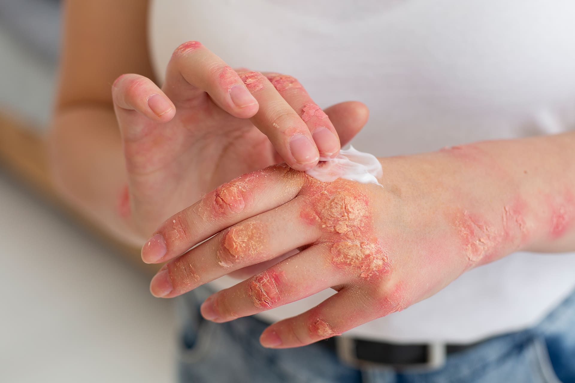 eczema treatment